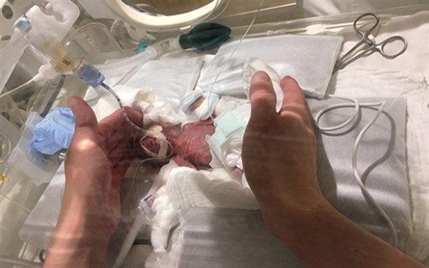Japonya’da 268 gram doğan bebek taburcu edildi