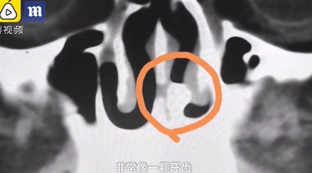 Çin'de bir adam, 20 yıl boyunca hiç farkına varmadan burnundaki dişle yaşadı