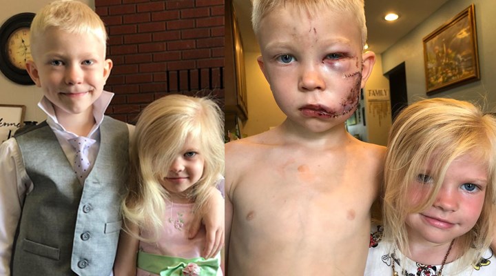 6 yaşındaki çocuk kardeşini köpek saldırısından kurtarmak için araya girdi