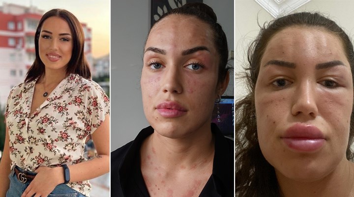 "Gençlik aşısı" adı altında cildine işlem yapılan genç kadından suç duyurusu