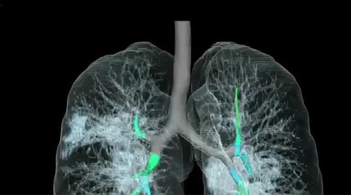 Bilim Kurulu Üyesi Turan: Virüsün yarattığı akciğer hasarı inanılmaz