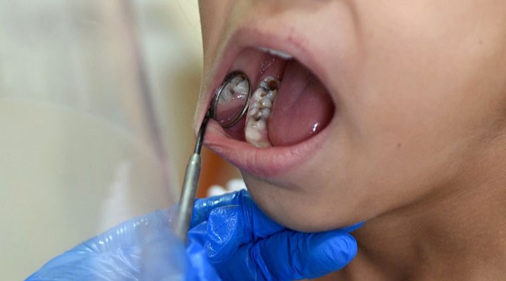 Tedavi edilmeyen diş iltihabında ölümcül 'mediastinit' riski uyarısı