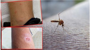 Doktorlar uyarıyor: İstanbul'da sivrisinekler hastanelik etmeye başladı!