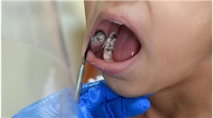 Tedavi edilmeyen diş iltihabında ölümcül 'mediastinit' riski uyarısı