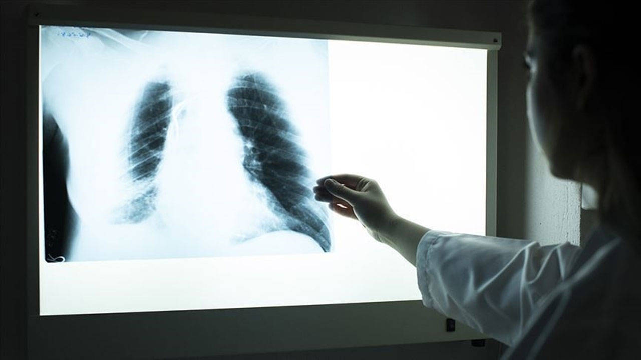 Tedavi edilmeyen 'varis' akciğer embolisine neden olabilir